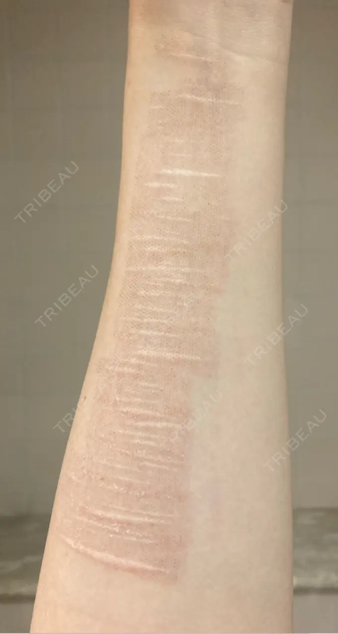 傷跡修正 きずときずあとのクリニック 銀座院 DAY 11 メイン用