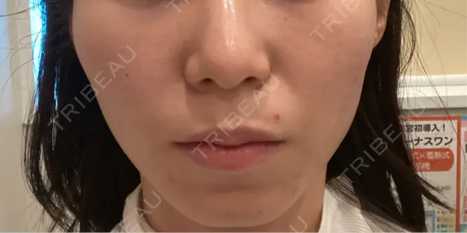 ピーリング（ニキビ・毛穴） / エレクトロポレーション Leap beauty clinic AFTER メイン用