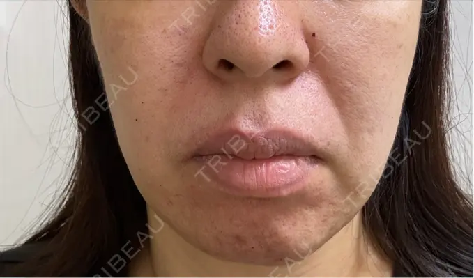 ボトックス（あご） / ボトックス（口角） / マイクロボトックス / ボトックス（眉間） / ボトックス（首） M'sクリニック【エムズクリニック】 DAY 0 メイン用