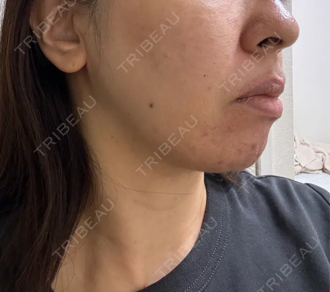 ボトックス（あご） / ボトックス（口角） / マイクロボトックス / ボトックス（眉間） / ボトックス（首） M'sクリニック【エムズクリニック】 DAY 0 メイン用