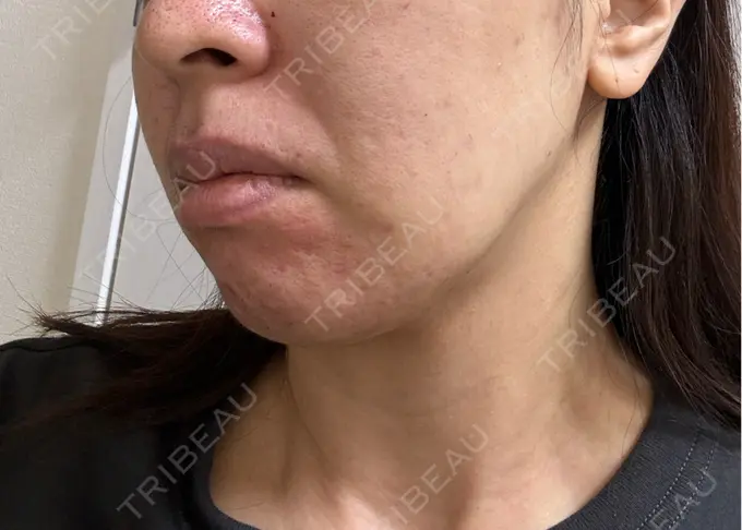 ボトックス（あご） / ボトックス（口角） / マイクロボトックス / ボトックス（眉間） / ボトックス（首） M'sクリニック【エムズクリニック】 DAY 0 メイン用