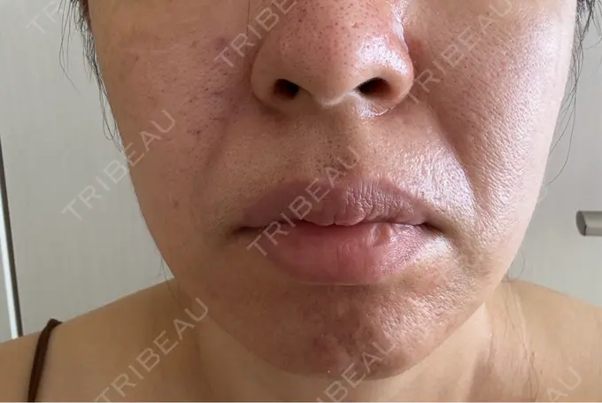 ボトックス（あご） / ボトックス（口角） / マイクロボトックス / ボトックス（眉間） / ボトックス（首） M'sクリニック【エムズクリニック】 AFTER メイン用