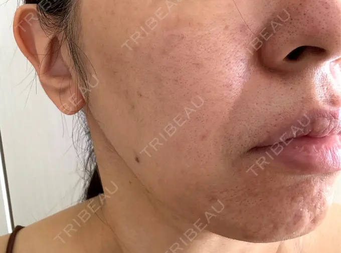 ボトックス（あご） / ボトックス（口角） / マイクロボトックス / ボトックス（眉間） / ボトックス（首） M'sクリニック【エムズクリニック】 DAY 1 メイン用