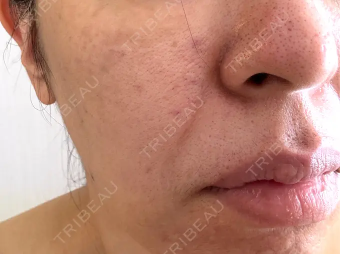 ボトックス（あご） / ボトックス（口角） / マイクロボトックス / ボトックス（眉間） / ボトックス（首） M'sクリニック【エムズクリニック】 DAY 1 メイン用