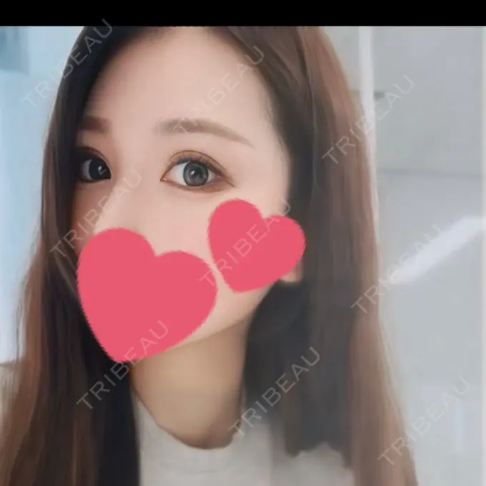 二重埋没 / 目頭切開 Brandnew Beauty Clinic AFTER メイン用