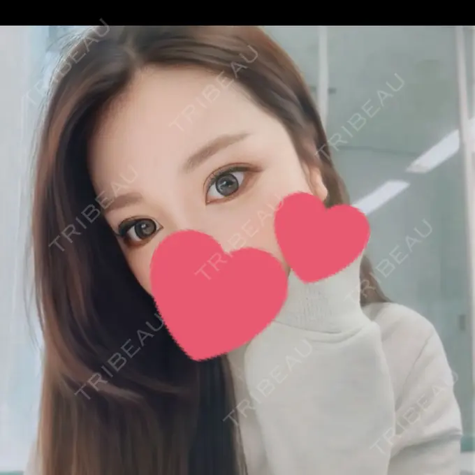 二重埋没 / 目頭切開 Brandnew Beauty Clinic DAY 368 メイン用