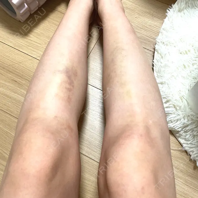 豊胸（脂肪注入） BBC銀座院 DAY 23 メイン用