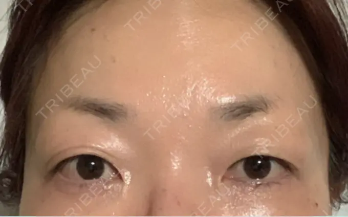 ボトックス（眉間） / ボトックス（目尻） / ボトックス（額） / その他（目元） TCB東京中央美容外科 名古屋栄院 AFTER メイン用