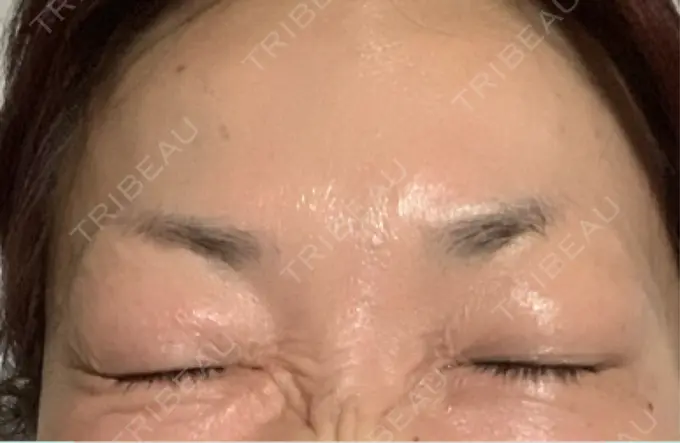 ボトックス（眉間） / ボトックス（目尻） / ボトックス（額） / その他（目元） TCB東京中央美容外科 名古屋栄院 DAY 15 メイン用