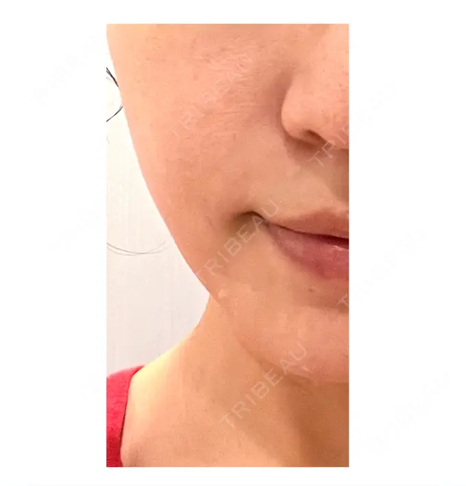 肌ヒアルロン酸注入（たるみ・シワ改善） / ボトックス（エラ・小顔） TCB東京中央美容外科 池袋駅前院 DAY 8 メイン用