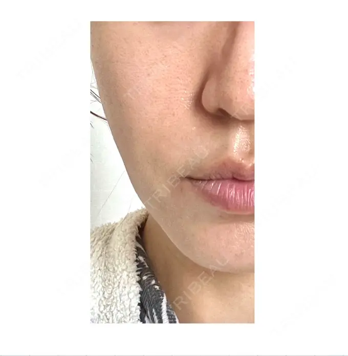 肌ヒアルロン酸注入（たるみ・シワ改善） / ボトックス（エラ・小顔） TCB東京中央美容外科 池袋駅前院 AFTER メイン用