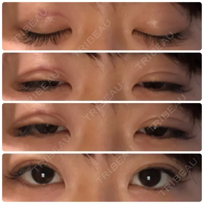 二重埋没 湘南美容クリニック 長野院 AFTER メイン用