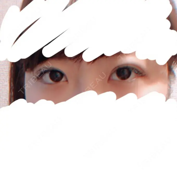 二重埋没 湘南美容クリニック 長野院 DAY 11 メイン用