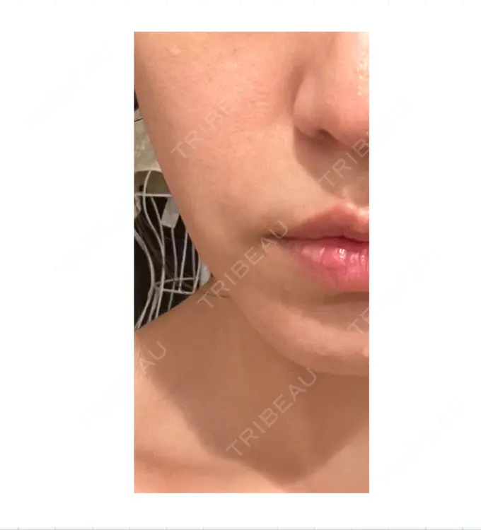 肌ヒアルロン酸注入（たるみ・シワ改善） / ボトックス（エラ・小顔） TCB東京中央美容外科 池袋駅前院 DAY 11 メイン用