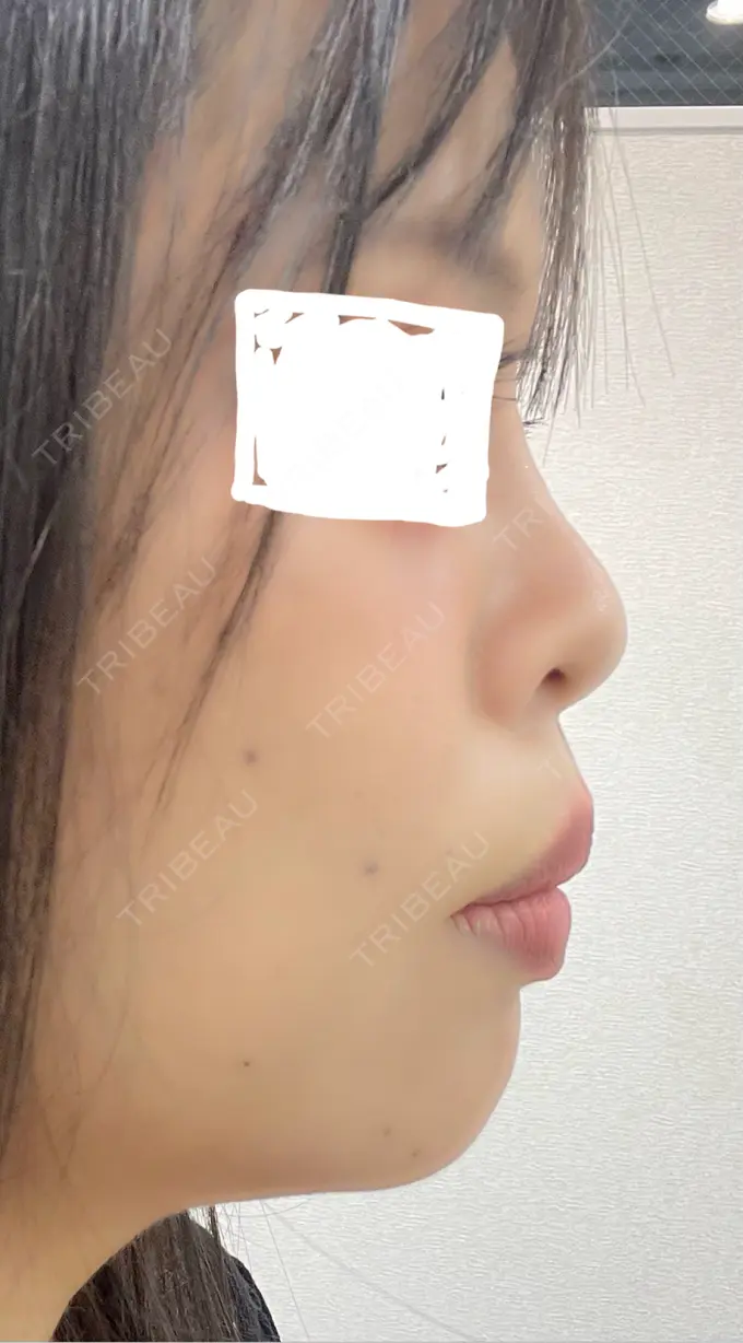 ヒアルロン酸注入（鼻） / ヒアルロン酸注入（あご） 新未来クリニック AFTER メイン用