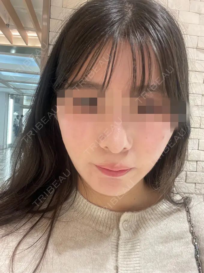 バッカルファット除去 / 脂肪吸引（顔） ルラ美容クリニック 大阪本院 AFTER メイン用