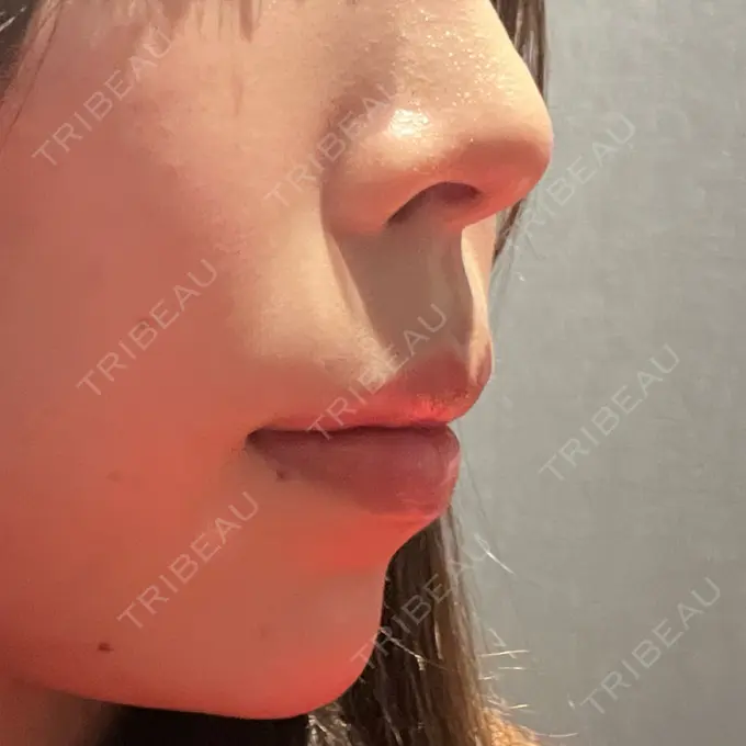 ヒアルロン酸注入（あご） Code Beauty Clinic 名古屋院 AFTER メイン用