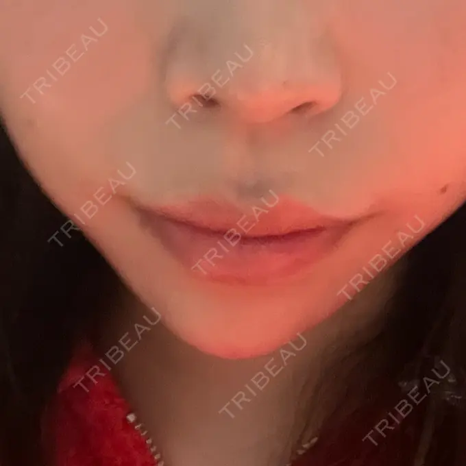 ヒアルロン酸注入（あご） Code Beauty Clinic 名古屋院 DAY 0 メイン用