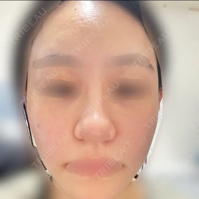 ピコレーザートーニング（美白・肝斑） 美容皮膚科エルムクリニック 大阪院 AFTER メイン用