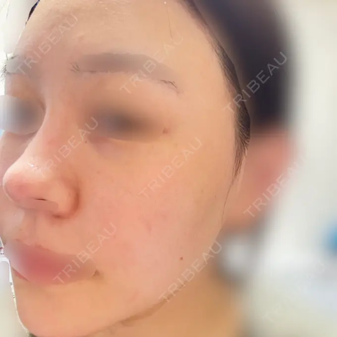 ピコレーザートーニング（美白・肝斑） 美容皮膚科エルムクリニック 大阪院 DAY 2 メイン用