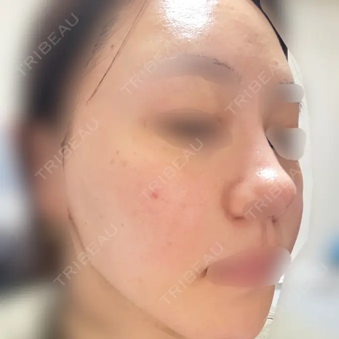 ピコレーザートーニング（美白・肝斑） 美容皮膚科エルムクリニック 大阪院 DAY 2 メイン用