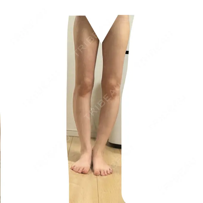 脂肪吸引（脚） / 脂肪吸引（お尻） Mods Clinic（モッズクリニック） 名古屋院 DAY 35 メイン用