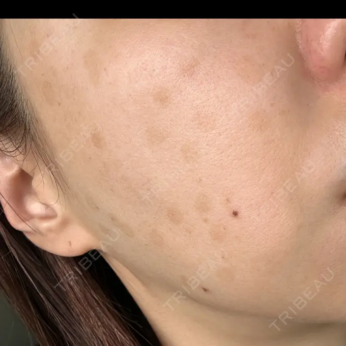 ピコレーザートーニング（美白・肝斑） G MEDICAL ART クリニック 新宿院 DAY 113 メイン用