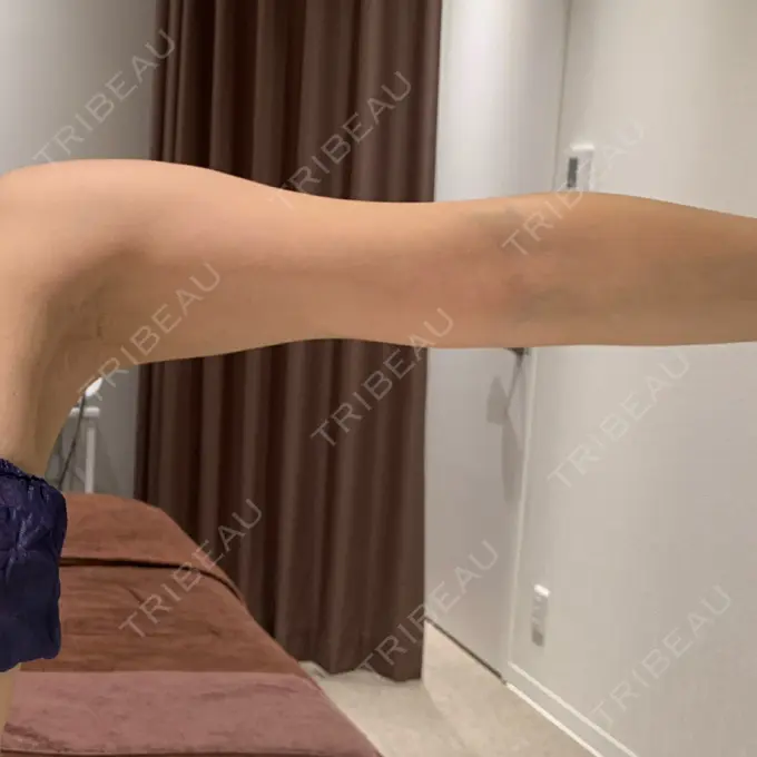 脂肪吸引（二の腕） / 脂肪吸引（肩） Mods Clinic（モッズクリニック） 名古屋院 AFTER メイン用