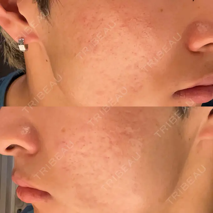 肌ヒアルロン酸注入（たるみ・シワ改善） / その他（肌） / ニキビ治療 ゆきスキンクリニック 東池袋 AFTER メイン用