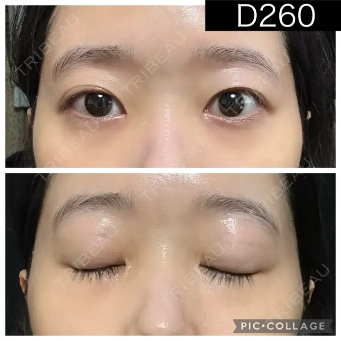 二重埋没 湘南美容クリニック 町田院 DAY 260 メイン用