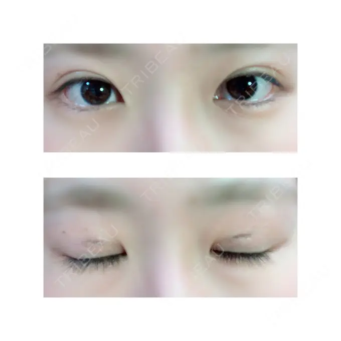 二重切開 有楽町高野美容クリニック DAY 13 メイン用