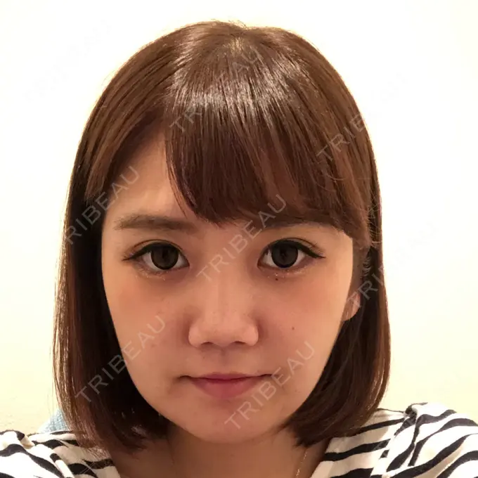 骨切り（あご） / 脂肪吸引（顔） 東京美容外科 赤坂院 DAY 19 メイン用