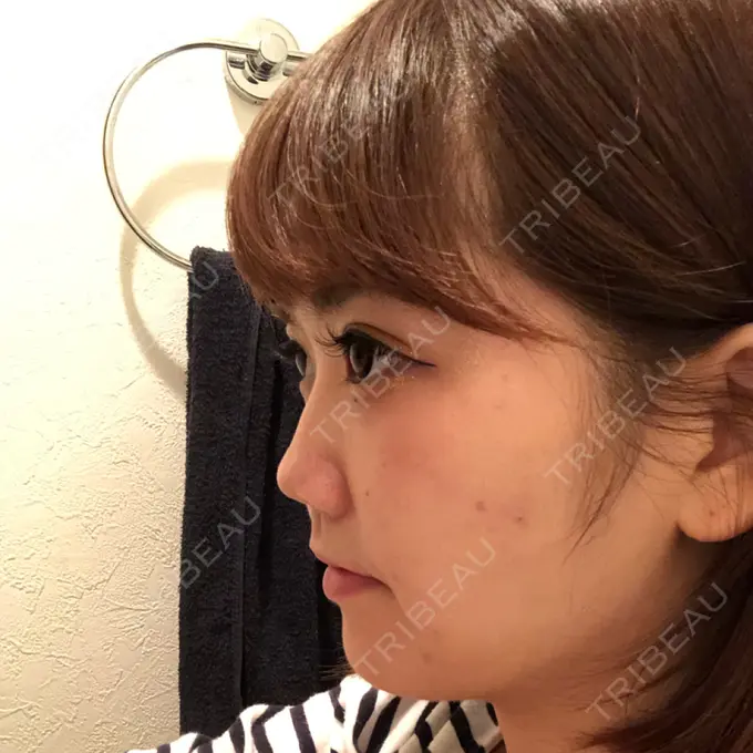 骨切り（あご） / 脂肪吸引（顔） 東京美容外科 赤坂院 DAY 19 メイン用