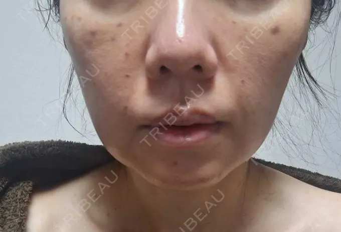 ボトックス（あご） / ボトックス（エラ・小顔） / ボトックス（額） もとび美容外科クリニック 新宿院 DAY 52 メイン用