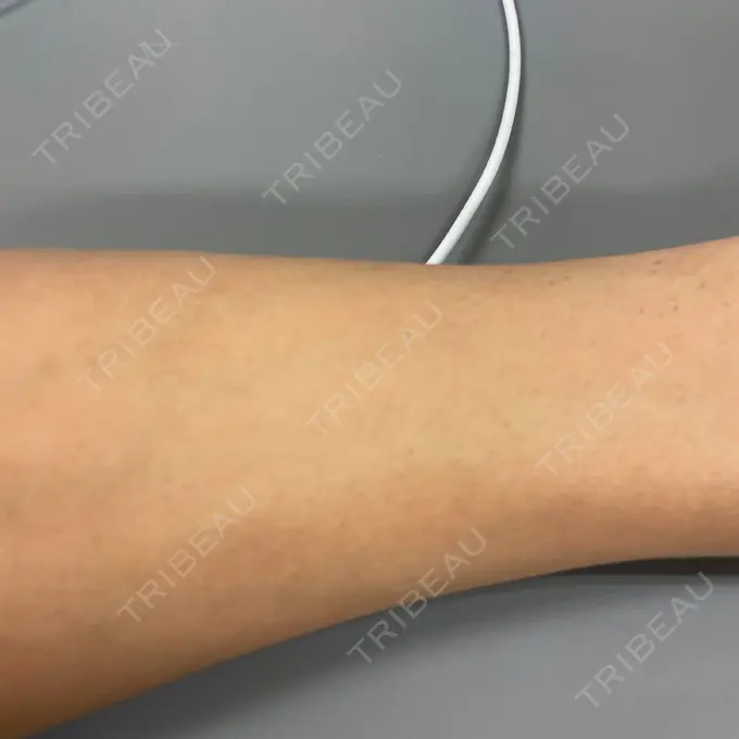 医療脱毛（腕） / 医療脱毛（お腹） / 医療脱毛（胸） 表参道メディカルクリニック 新宿院 DAY 17 メイン用