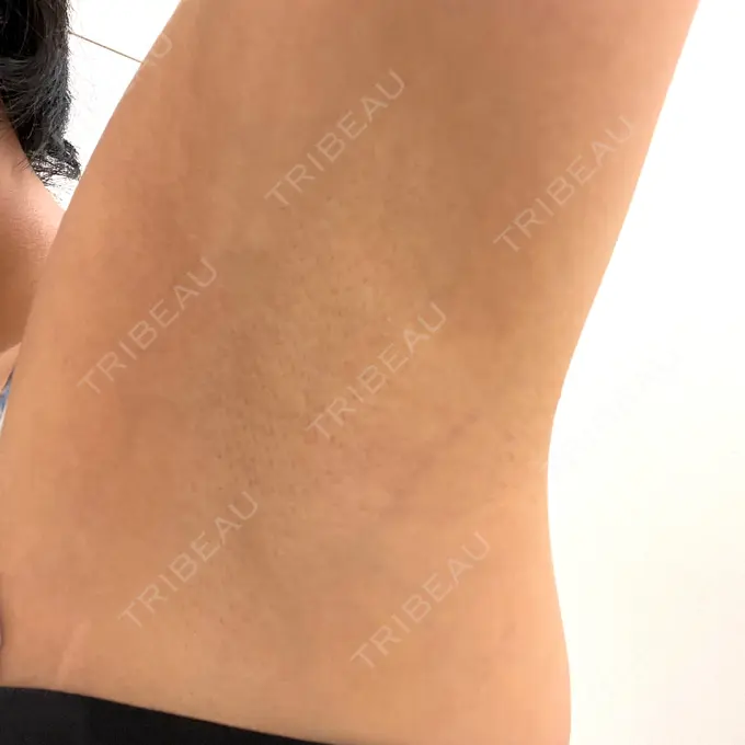 ワキ汗治療（ボトックス） DMTC美容皮膚科 大宮院 DAY 1 メイン用