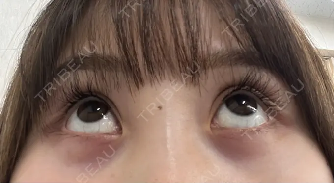 アートメイク（アイライン） Kinshicho Beauty Clinic （錦糸町ビューティークリニック） DAY 3 メイン用