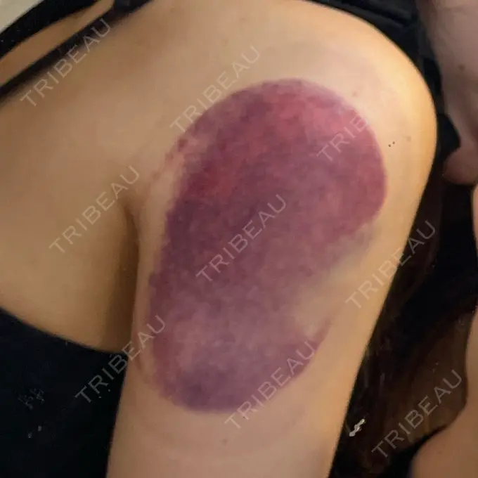 脂肪冷却（お腹） / 脂肪冷却（二の腕） DMTC CLINIC 日本橋院 DAY 0 メイン用