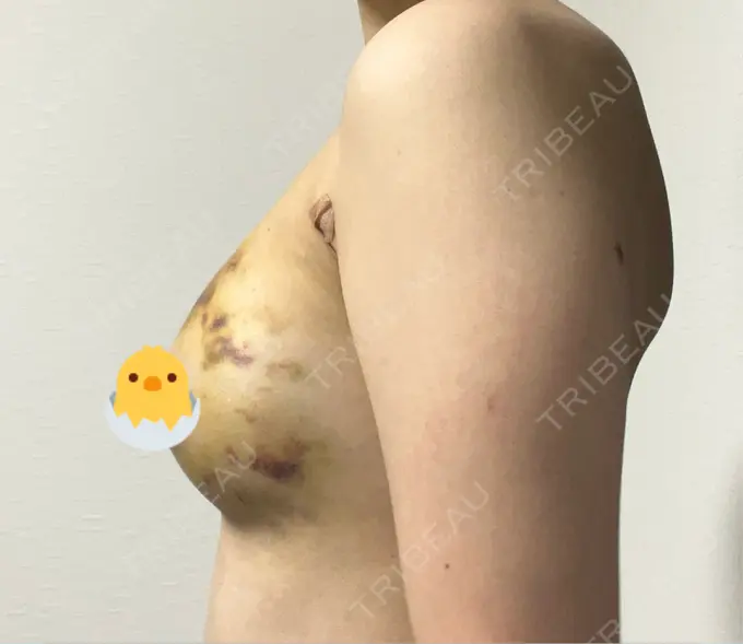 豊胸（脂肪注入） 湘南美容クリニック 新百合ヶ丘院 DAY 7 メイン用