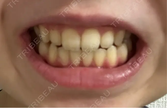 ホワイトニング LEAGRANT CLINIC 中目黒 DAY 14 メイン用