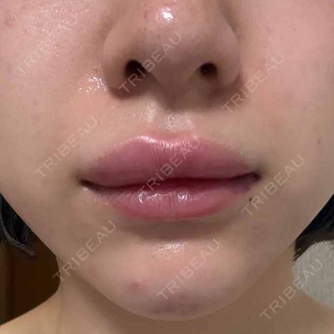 ヒアルロン酸注入（あご） / ボトックス（エラ・小顔） / ヒアルロン酸注入（唇） 日比谷セントラルクリニック DAY 0 メイン用