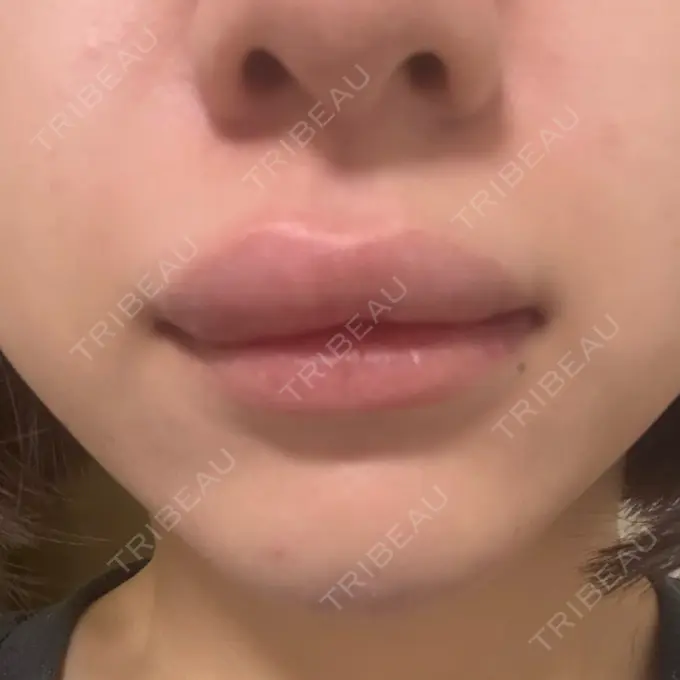 ヒアルロン酸注入（あご） / ボトックス（エラ・小顔） / ヒアルロン酸注入（唇） 日比谷セントラルクリニック DAY 1 メイン用