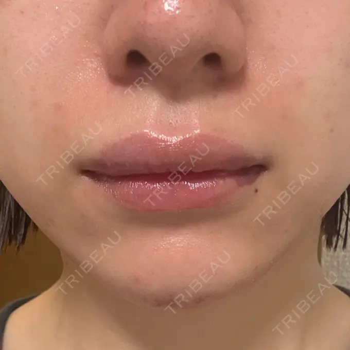 ヒアルロン酸注入（あご） / ボトックス（エラ・小顔） / ヒアルロン酸注入（唇） 日比谷セントラルクリニック AFTER メイン用