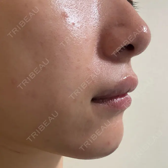 ヒアルロン酸注入（あご） / ボトックス（エラ・小顔） / ヒアルロン酸注入（唇） 日比谷セントラルクリニック DAY 2 メイン用