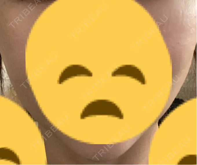 糸リフト / 脂肪吸引（顔） / 下まぶたの脂肪取り / 脂肪注入（目の下） 東京ココセランクリニック DAY 11 メイン用