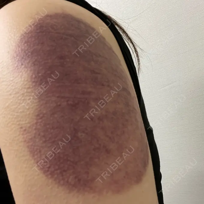 脂肪冷却（お腹） / 脂肪冷却（二の腕） DMTC CLINIC 日本橋院 DAY 1 メイン用