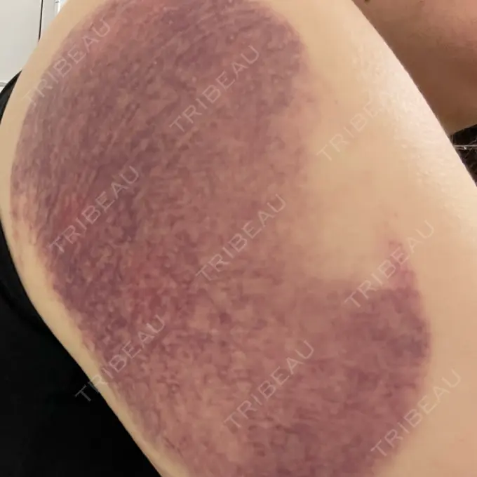 脂肪冷却（お腹） / 脂肪冷却（二の腕） DMTC CLINIC 日本橋院 DAY 1 メイン用