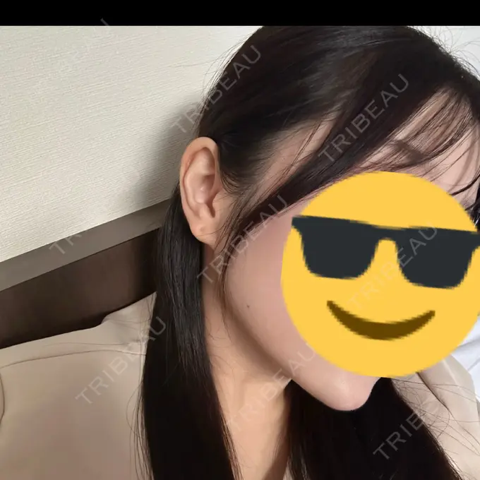 ハイフ（顔） 椿クリニック 心斎橋院 AFTER メイン用