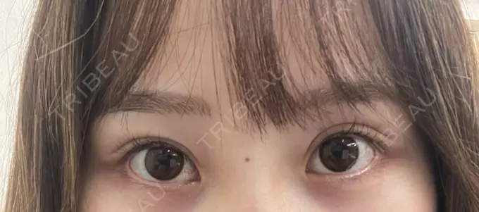 アートメイク（アイライン） Kinshicho Beauty Clinic （錦糸町ビューティークリニック） DAY 5 メイン用