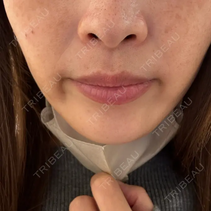 医療脱毛（顔） 共立美容外科 熊本院 DAY 0 メイン用